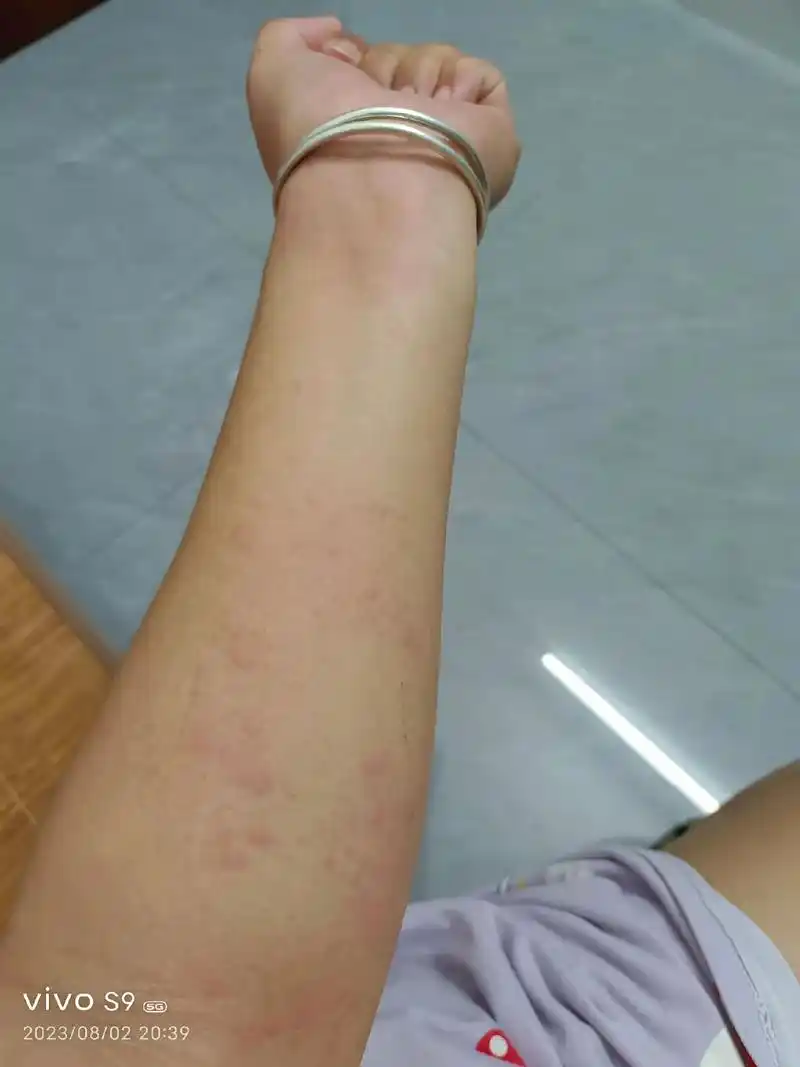 广东的蚂蚁真是毒死了,晚上就坐在公园里一会,被几个小红蚂蚁咬 - 抖