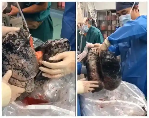 烟民的肺是如何"黑化"的?看完赶紧掐掉手中的烟