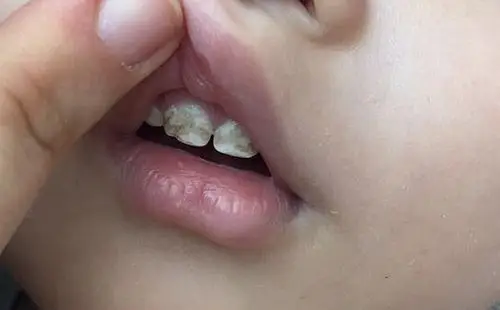 不到2岁的宝宝,门牙已经开始变得坑坑洼洼了.