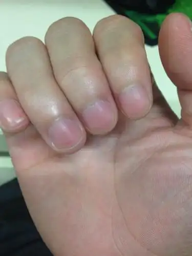 从手指甲里看出,我有什么健康问题吗?