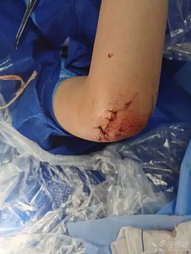 儿童左桡骨头颈骨折并肱骨内髁骨折一例.欢迎各位同道指导建议.