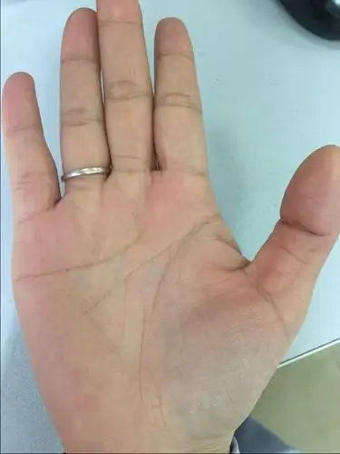 手掌到处可见青紫色的青筋,表示肠胃积滞,血脂高,血粘高,血压高,血液