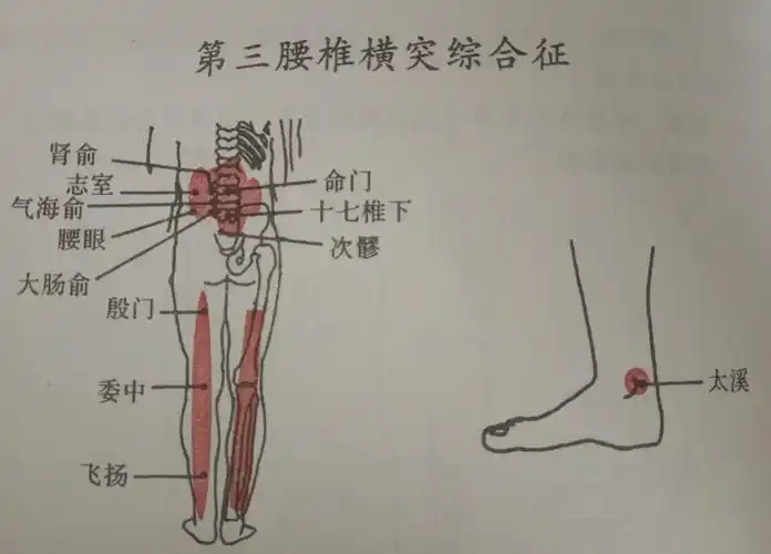 第三腰椎横突综合征