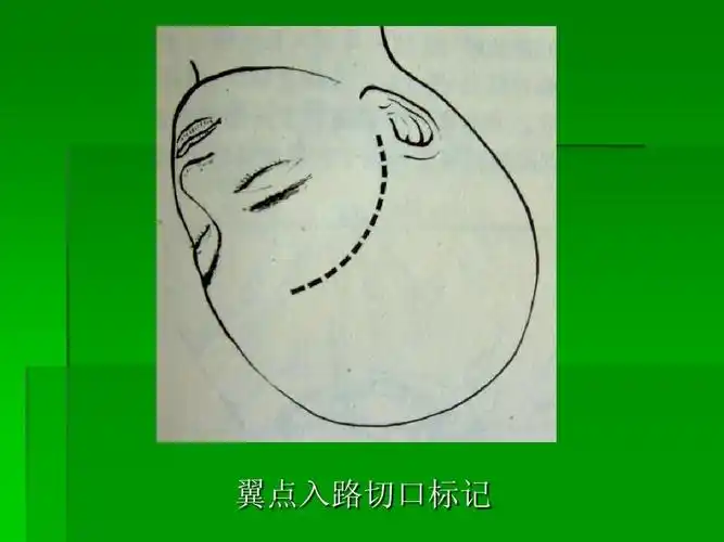 翼点入路切口标记