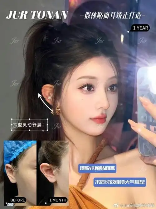 贴面耳矫正