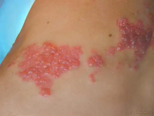 "缠腰龙"缠腰一圈会死人,这不是真的!