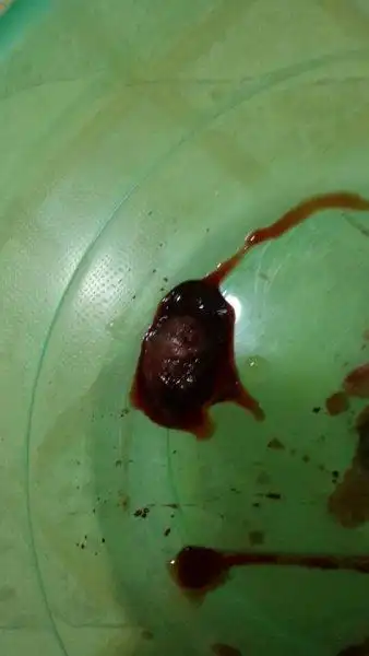 吃完药流孕囊掉下来后身体