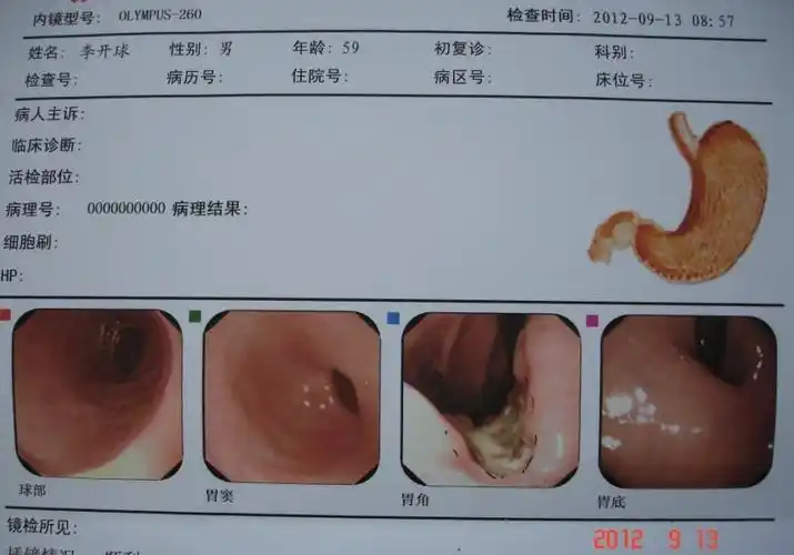 请医生帮我分析下,这个应该是什么病,胃溃疡或者胃癌?