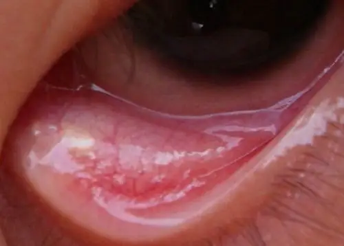 眼结石图片 (33)