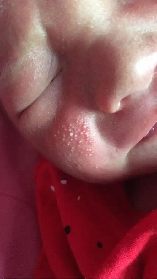 宝宝脸上长小白点