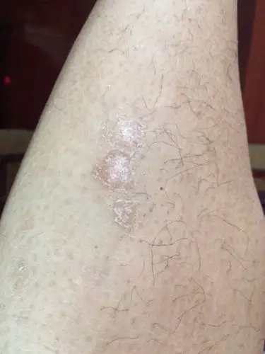 小腿前面板起皮.这是啥皮肤病?抹点啥?