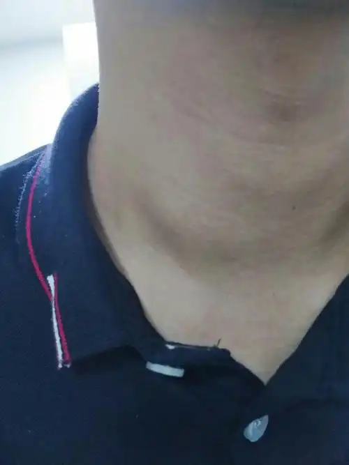 锁骨上面一点有个肿块,今天突然发现的,之前好像是没有的,摸着不痛也