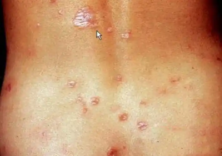 梅毒淋病口腔症状图片