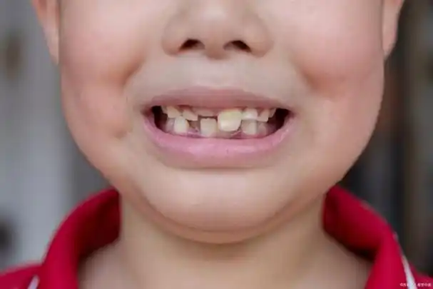 为什么会出现牙齿不齐?了解其原因和治疗方法