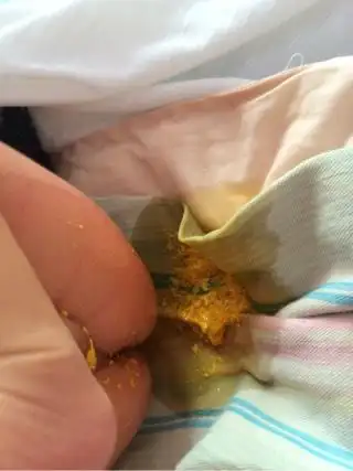 吃了母乳就大便