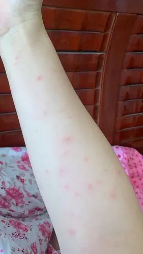 【讨论】疑似被跳蚤咬了,但猫没事