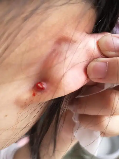 打耳洞后长了个肉球,怎么办(慎入)