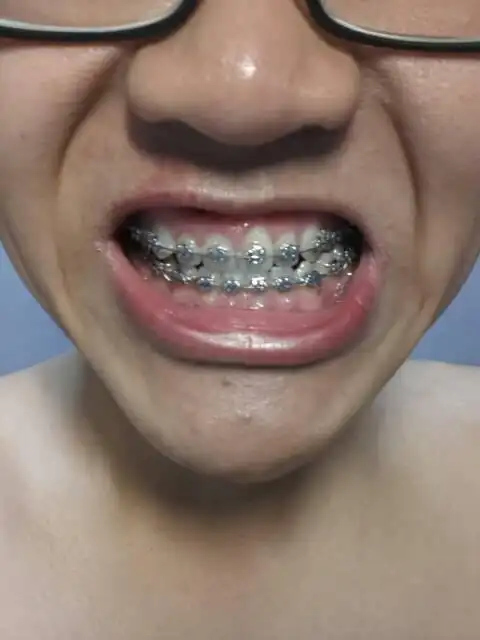 楼主今年17岁,高二,地包天,上医院检查说已经错过了最好的矫正年龄