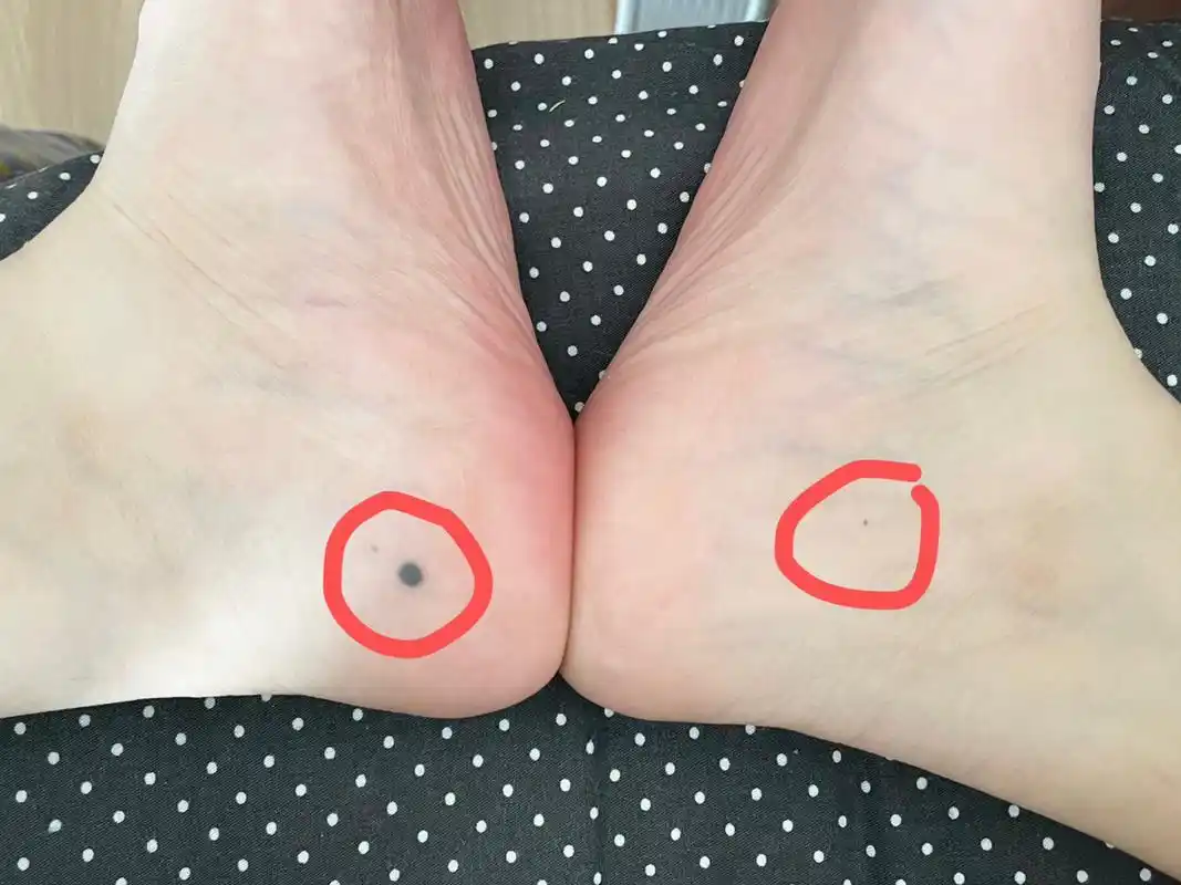 高出皮肤,我也没关心过,突然发现右脚脚后跟侧面居然又长了个新的痣差