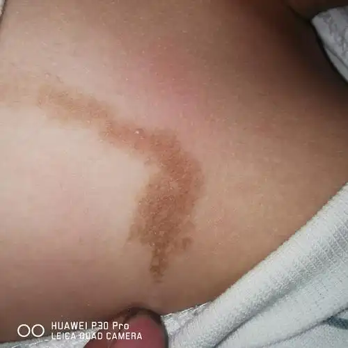 小孩胸口有个像胎记一样的东西,出生就有,现在越来越大了 有人知道这