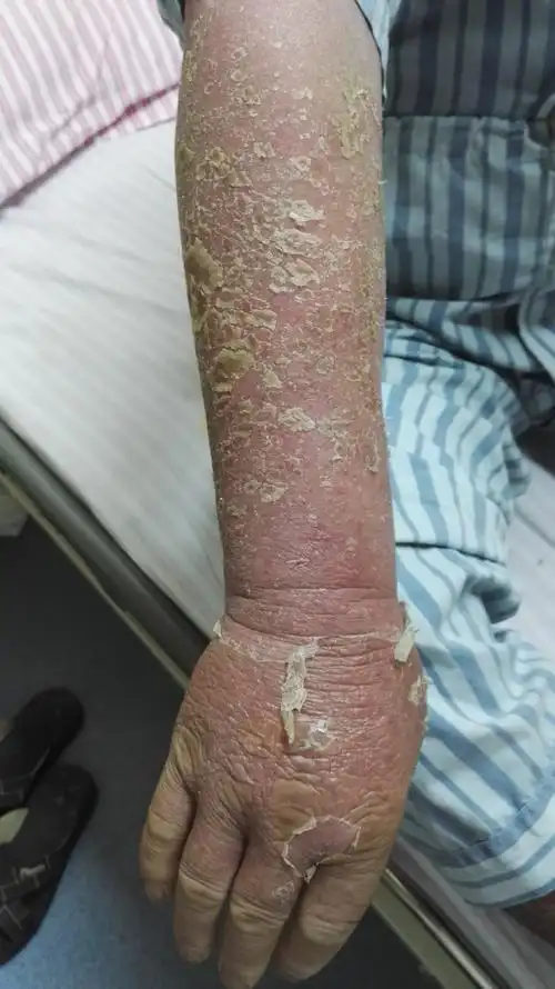 红皮病型银屑病高热1例 - 好大夫在线