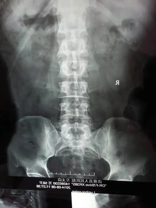 请问58岁的人横突骨折.5个多月能好吗.还能看出骨折吗.