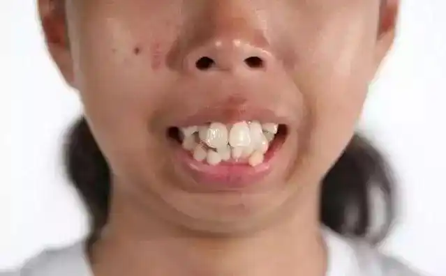 反面教材下面这一切就完了因为如果牙齿不好看牙齿要白要整齐要好看