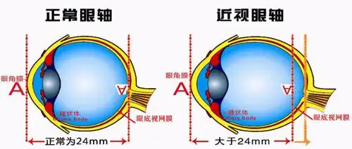 视网膜脱离怎么办?
