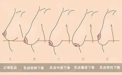 乳房下垂的原因其实只有3种