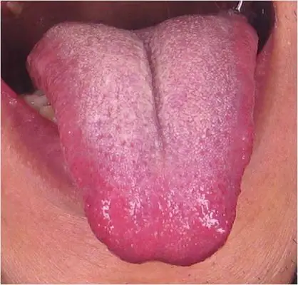 舌头发紫图片50