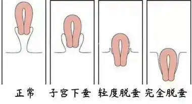 子宫脱垂图