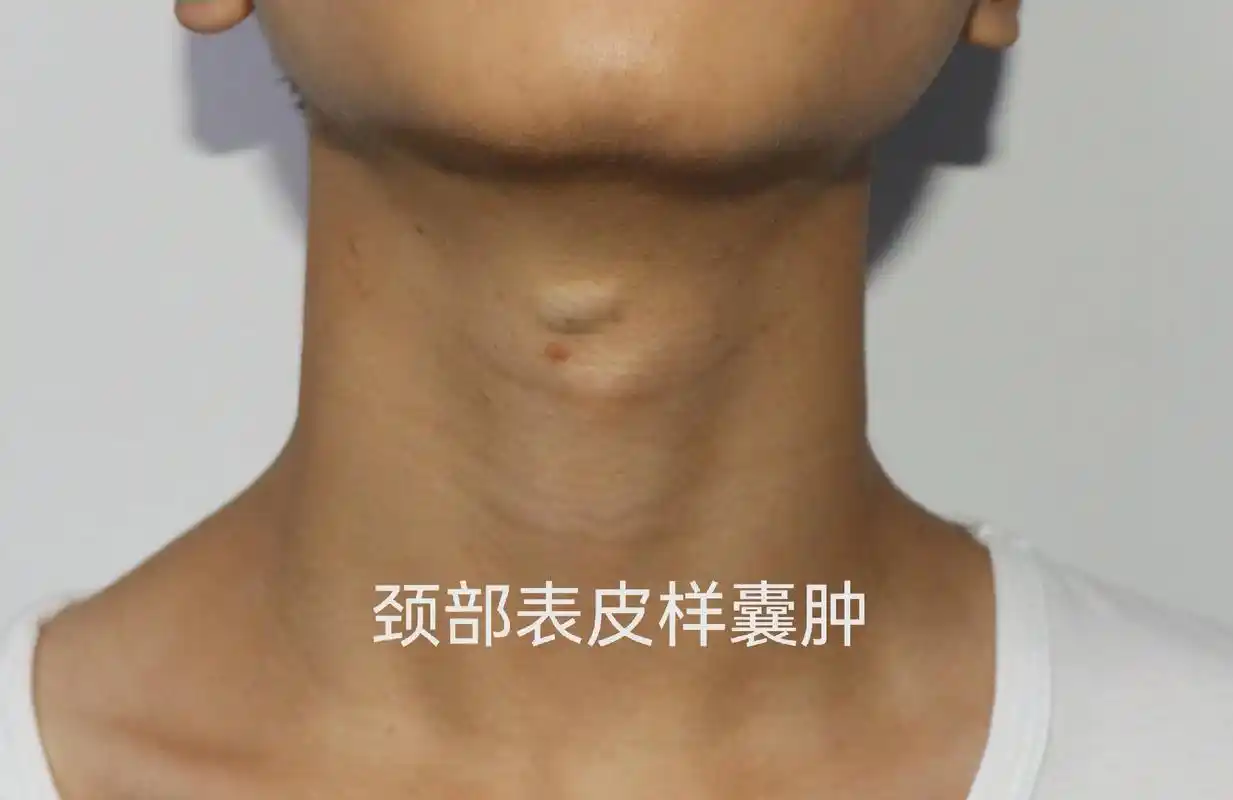 体表肿瘤微创手术——表皮囊肿.表皮囊肿,常见于头皮,面部,颈 - 抖音