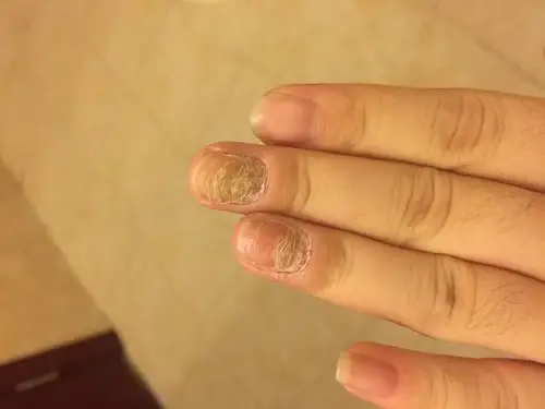 医生您好,我的手之前长湿疹了,用过一种药店推荐的药水,之后指_灰指甲