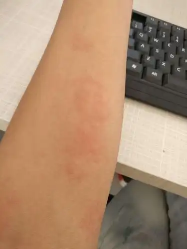 胳膊起红疙瘩很痒图