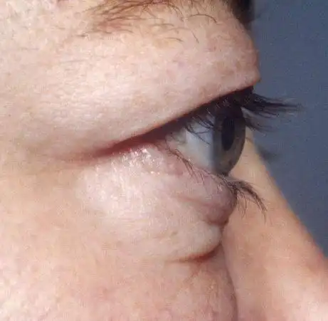 高度近视眼睛玩外凸可以做双眼皮吗