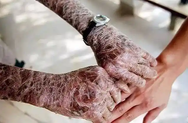 毒品有多毒让活人的肉体腐烂至可见白骨提醒图片高能惊心动魄