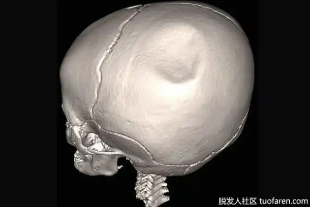 是什么导致颅骨凹陷