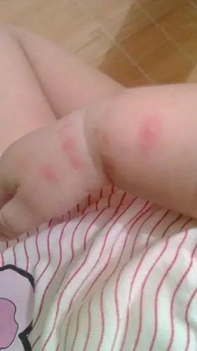 急,宝宝手臂长红疹,是什么?