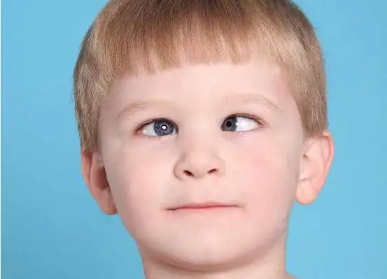 斗鸡眼面相好不好