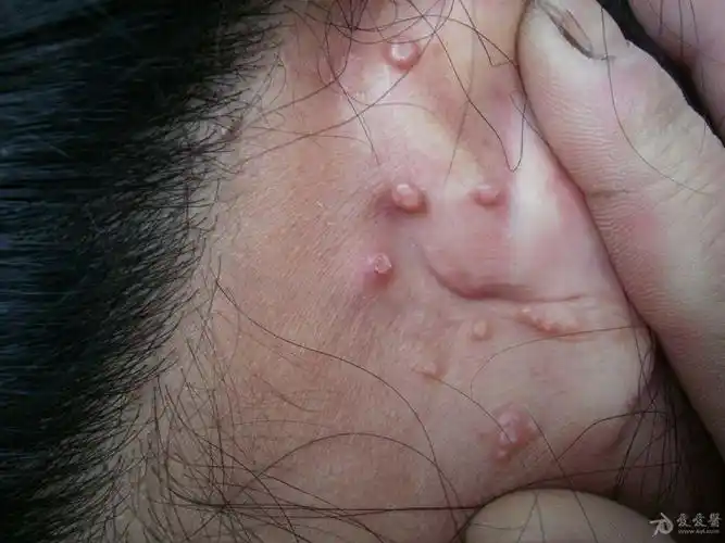 耳后传染性软疣