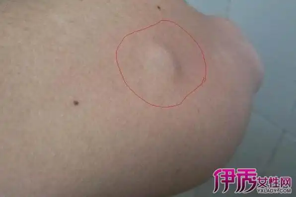 【图】粉瘤不手术怎么治疗 粉瘤有什么症状你知道吗?