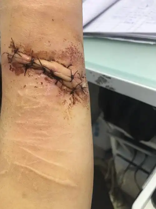 胳膊划坏了缝的针,已经六天了,外边伤口看着已经长好了,可不可