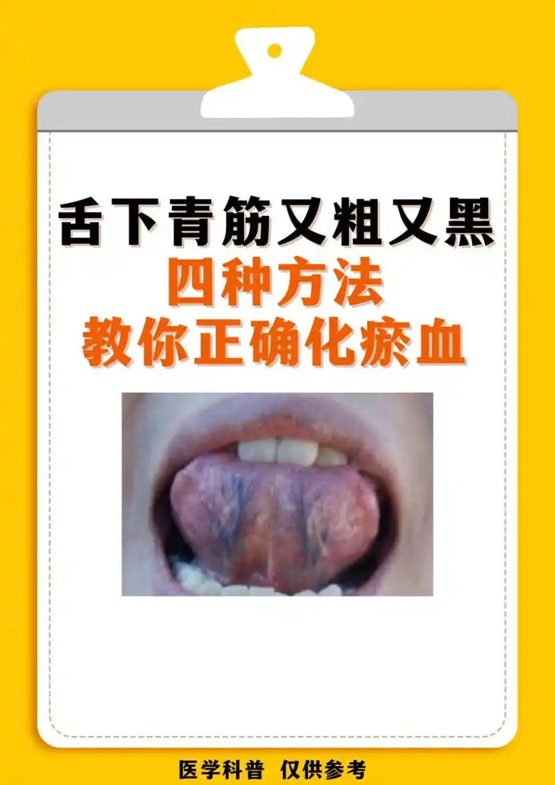 舌头下面青筋又黑又粗,教你四招轻松化淤血#舌苔# #淤血# #疏通淤血