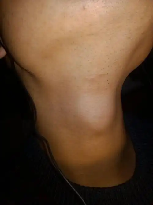 我的下巴下面有小突起,是淋巴结肿大,还是脂肪瘤啊,还是皮下组织问题?