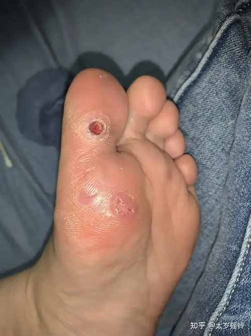 艰苦的液氮冷冻去跖疣过程