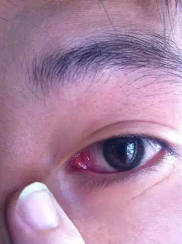 请问我眼珠旁边的是什么?