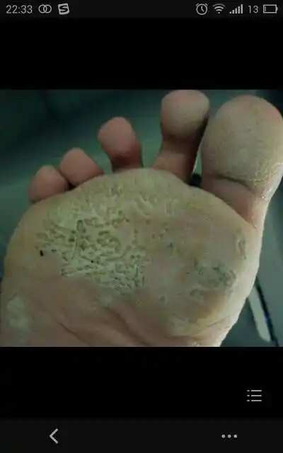 我老公以前有脚气,用过达克宁,还用过派瑞松,配合让