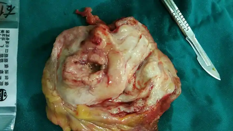 病人男,65岁,膀胱巨大肿瘤5*5cm,曾经于八个月内于外院两次行电切术