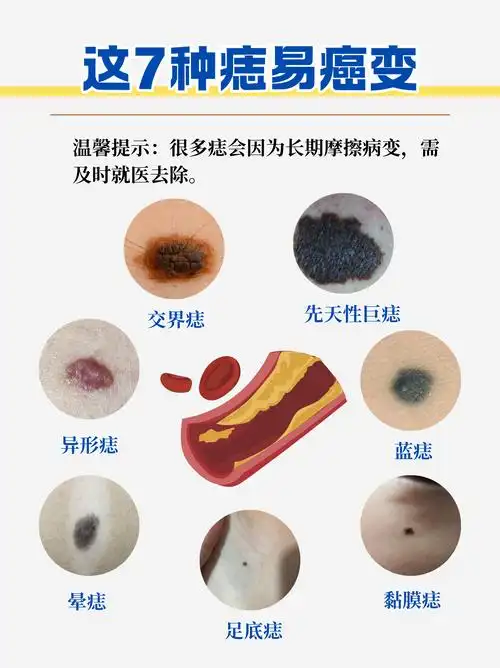这7种痣易癌变!