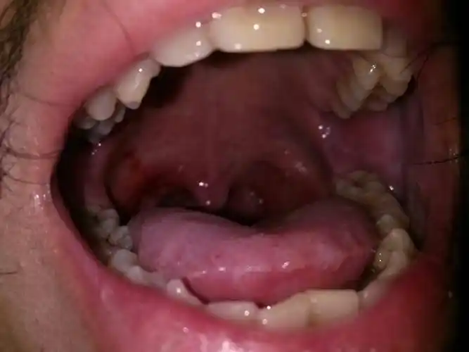 咽喉8天手术前 左右两侧有7处腐烂 所以做了组织检